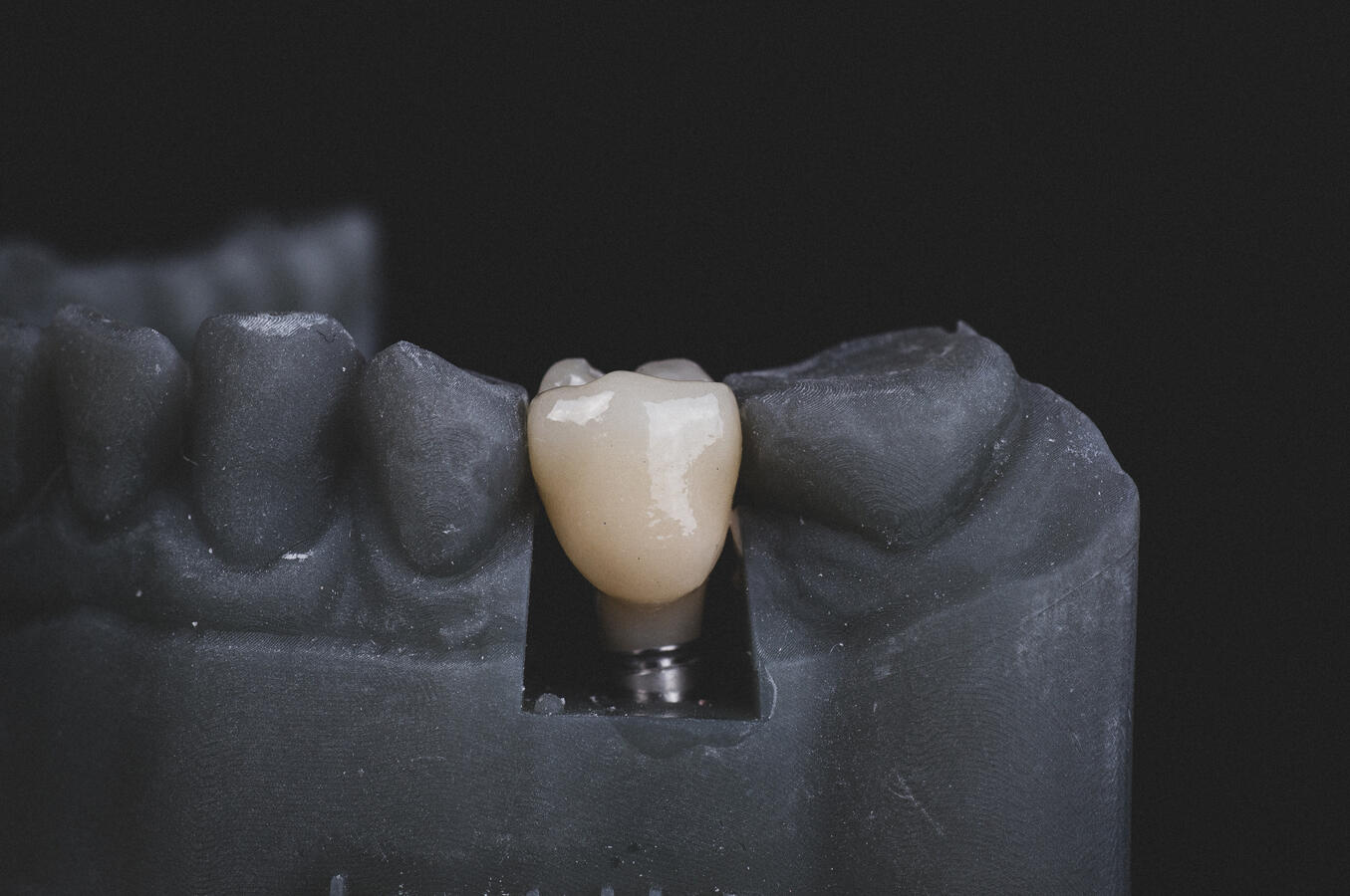 Implants Dentures Crowns